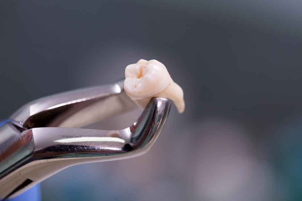 What to do With a Chipped Tooth
