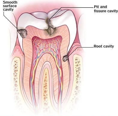 Kristen-Ritzau-DDS-Crowns-Fillings