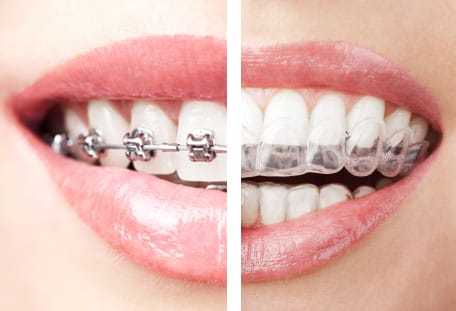 Invisalign or Braces