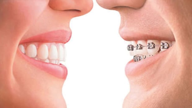 invisalign-vs-braces