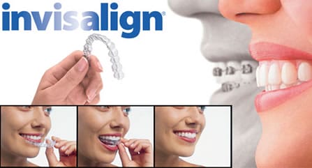 invisalign