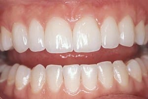 veneers-large