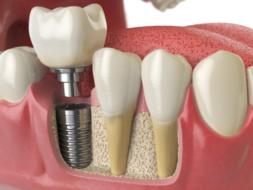 Are Dental Implants the Best Teeth Replacement Option