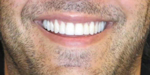 After Full upper arch cosmetic crowns with sedation