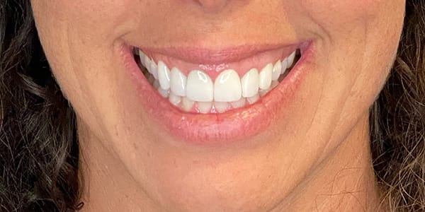 After Veneers