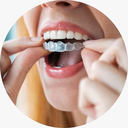 Invisalign In Mission Viejo