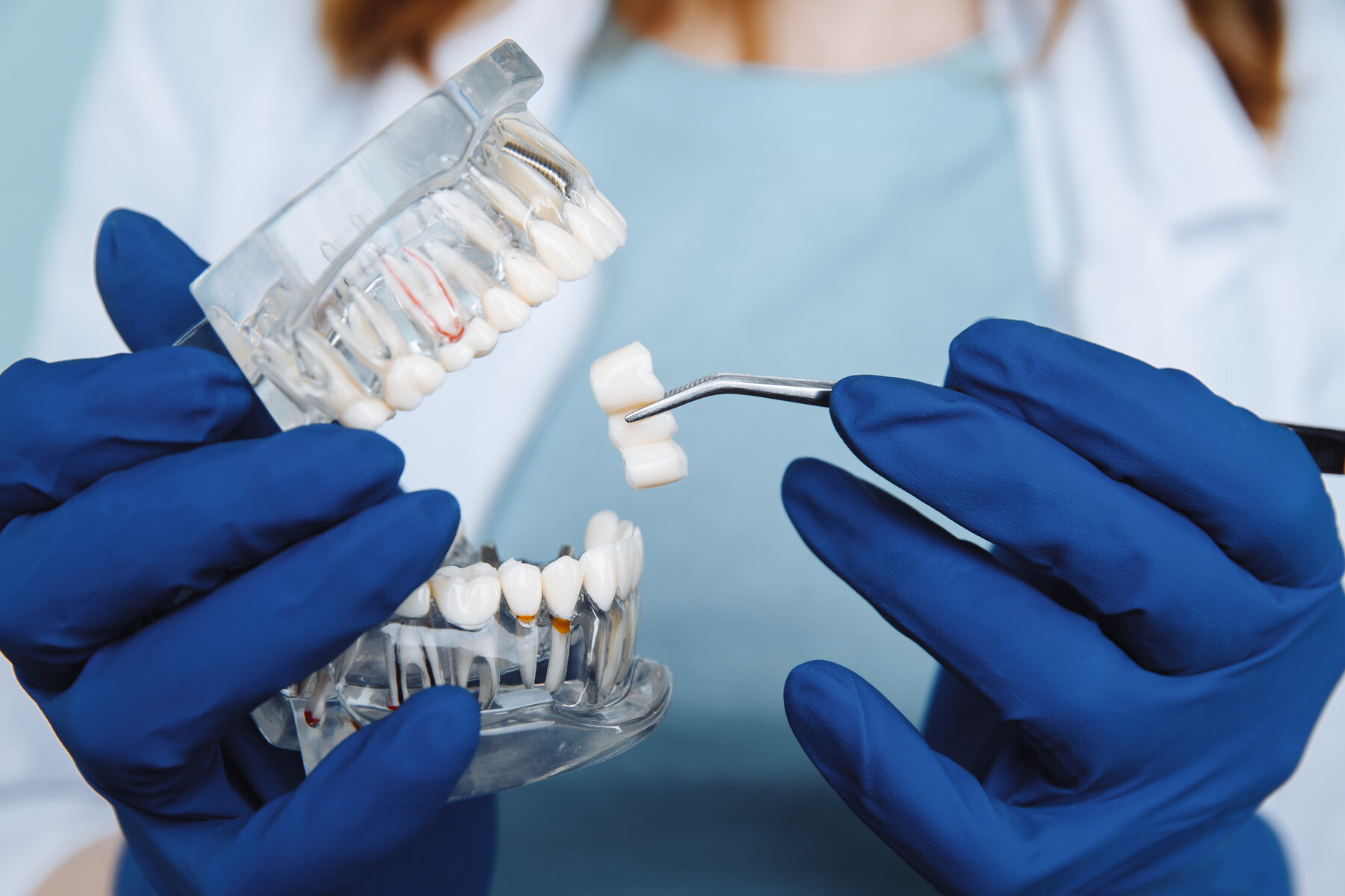 How Much Do Dental Crowns Cost? Factors Affecting the Price