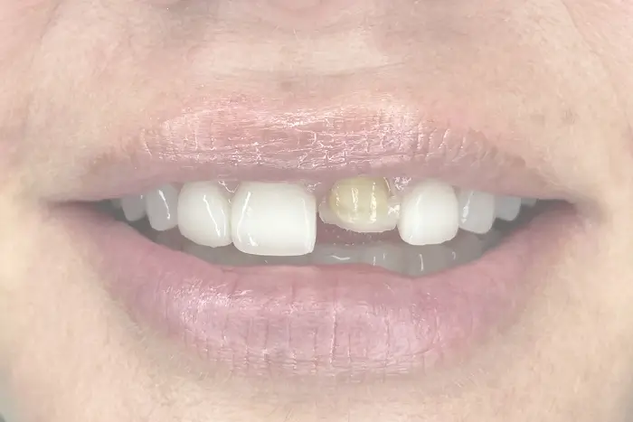 a close up of a person ' s mouth with a missing tooth