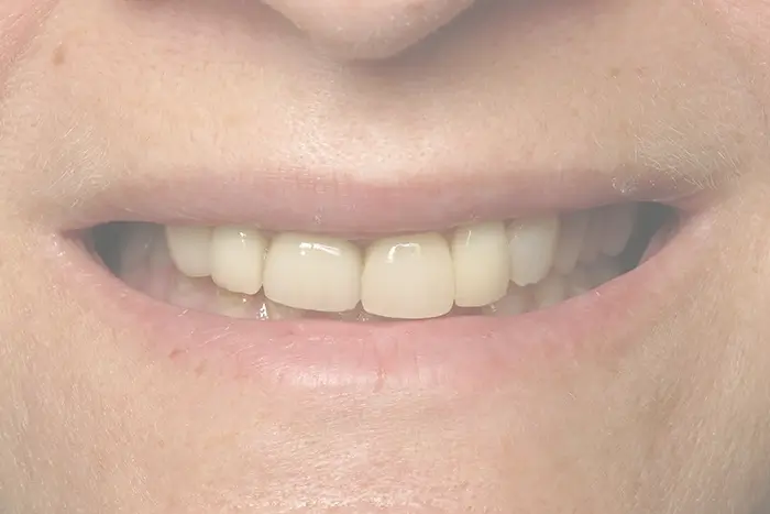 a close up of a person ' s mouth with a missing tooth