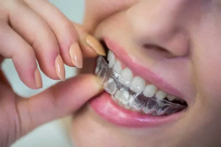 What Does Invisalign Look Like? How You Can Preview Your Smile Transformation
