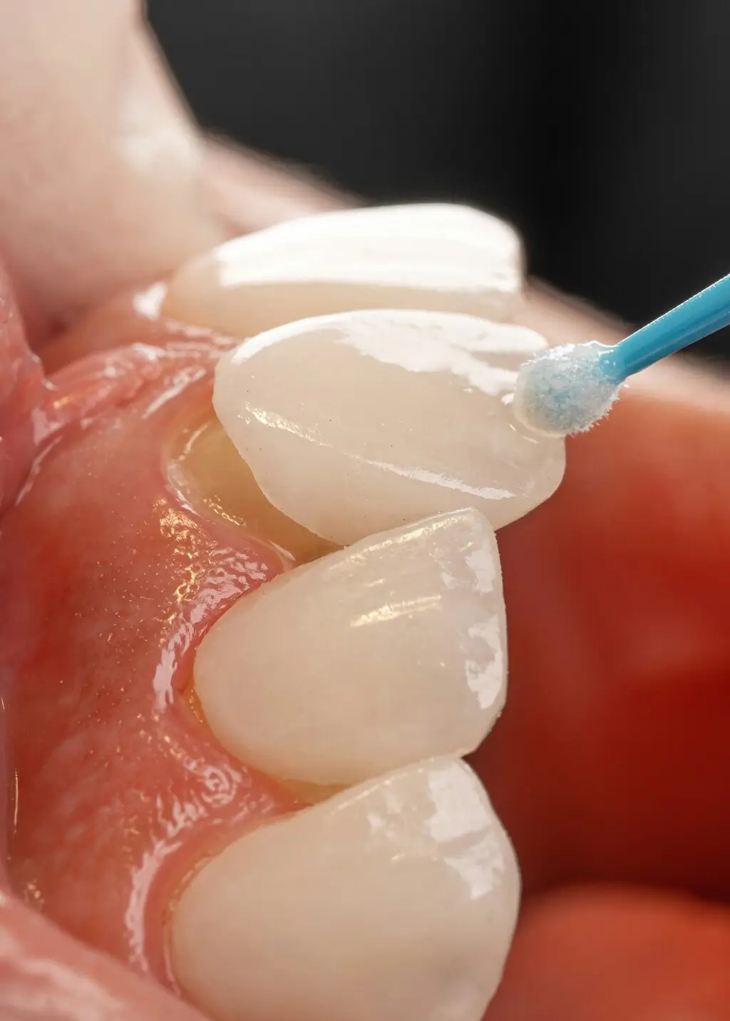 Close-up of a dental veneer being applied to a patient’s tooth using a small applicator brush.