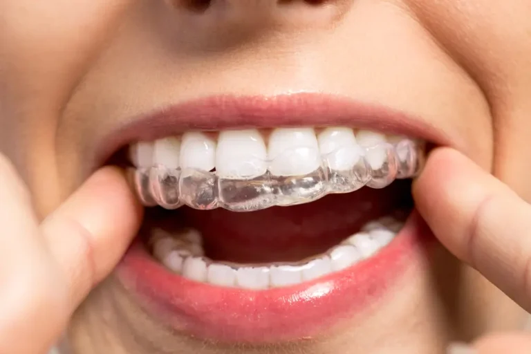 Adjusting to Invisalign: Speech Impact, Lisping & Tips to Adapt