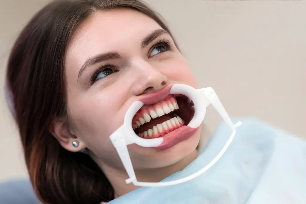 Clear Invisalign aligner tray displayed on a dental model with white teeth.
