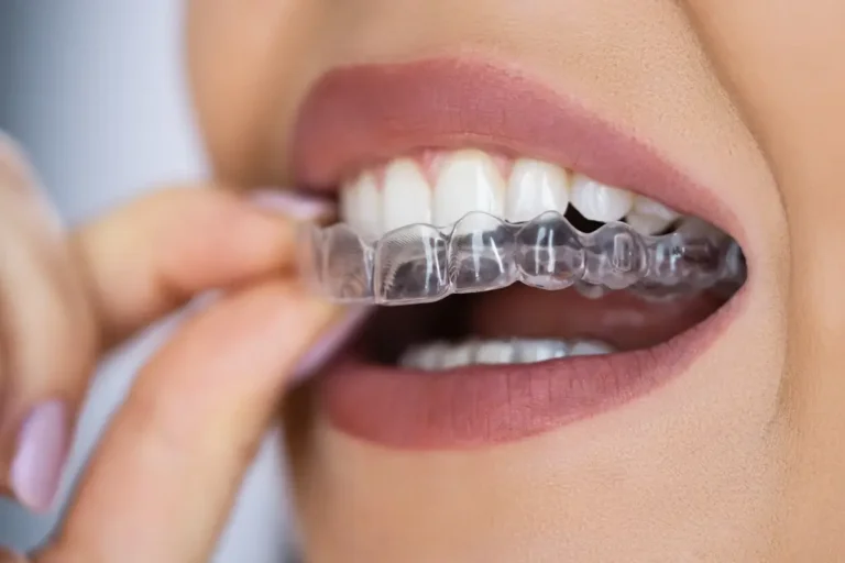 Close-up of a woman inserting a clear Invisalign aligner onto her upper teeth.