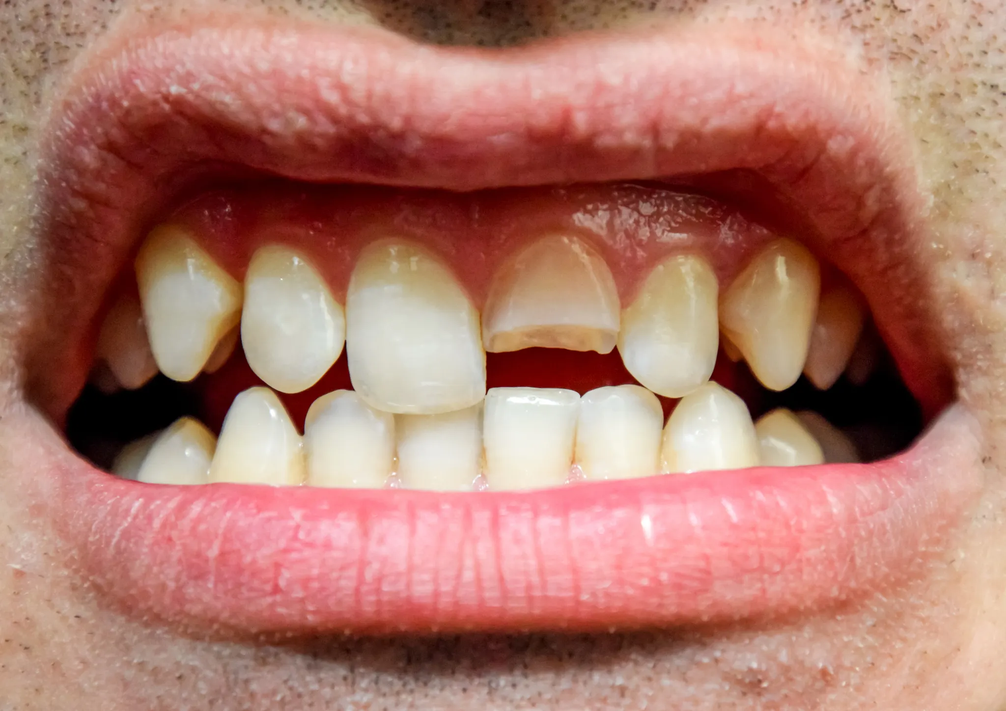 To Pull or Not to Pull? Modern Alternatives to Tooth Extraction