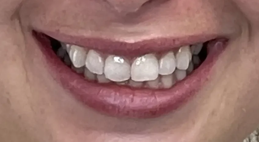 Dana_Burleson Invisalign before1